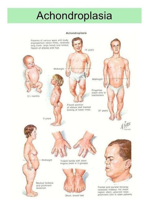 Loạn sản sụn Achondroplasia 3