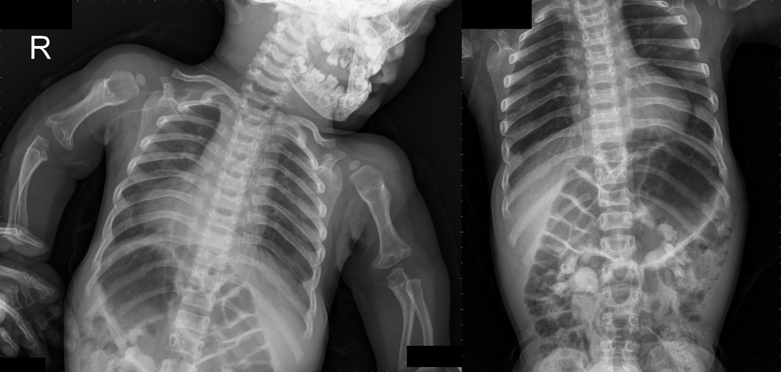 Loạn sản sụn Achondroplasia 5