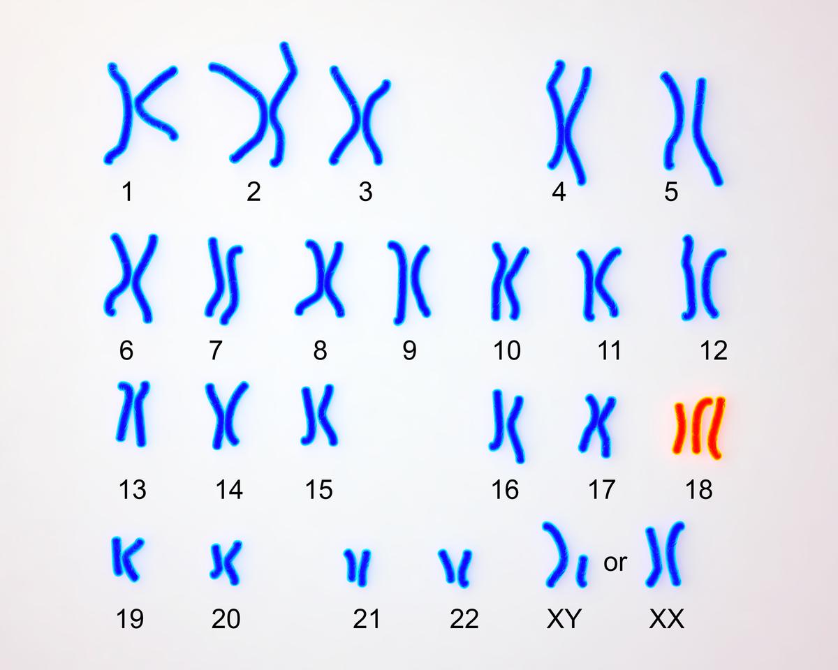 Hội chứng Edwards (Trisomy 18) 1