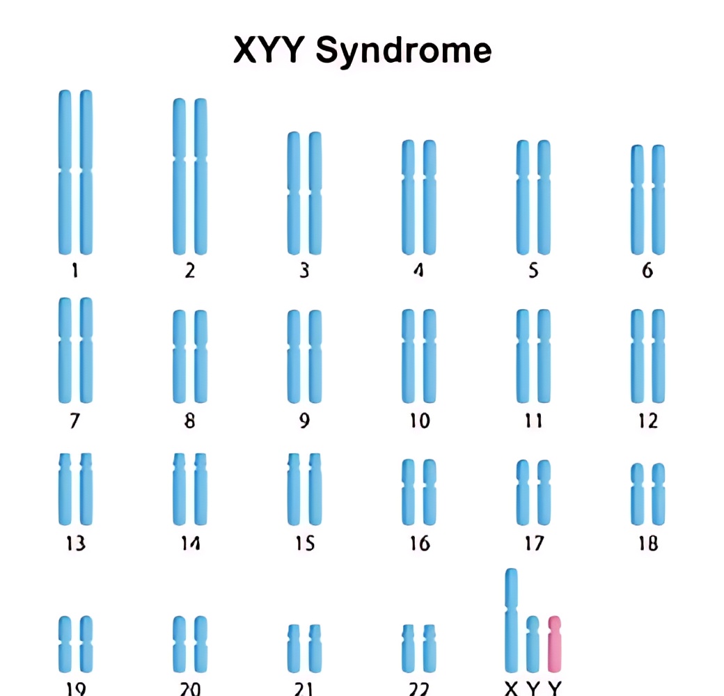 Hội chứng Jacobs (47,XYY) 1