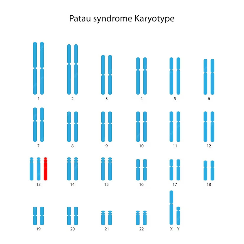 Hội chứng Patau (Trisomy 13) 1