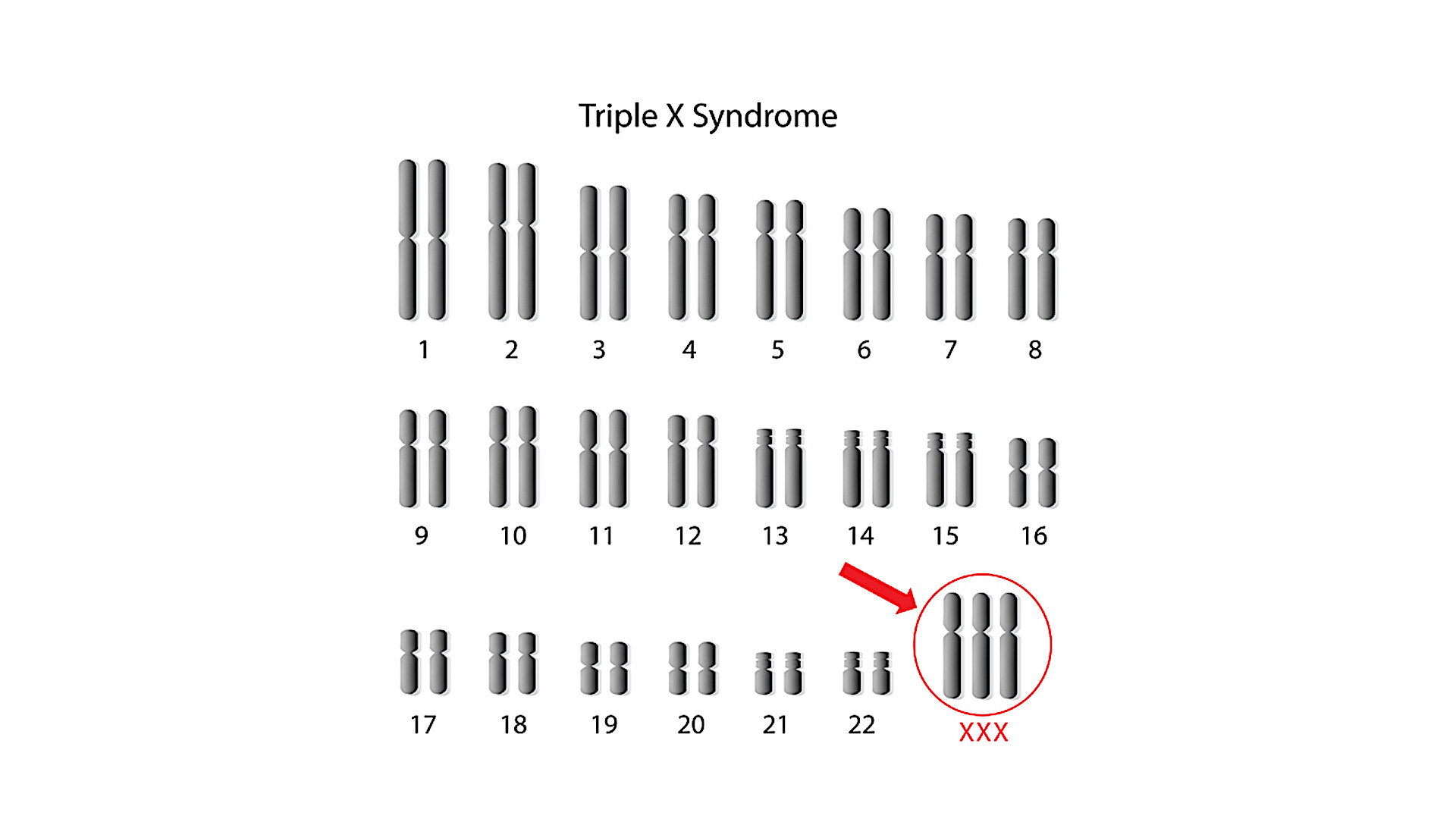 Hội chứng Triple X (47,XXX) 3