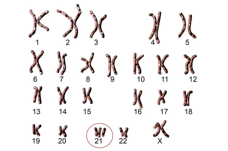 Hội chứng Down (Trisomy 21) 3