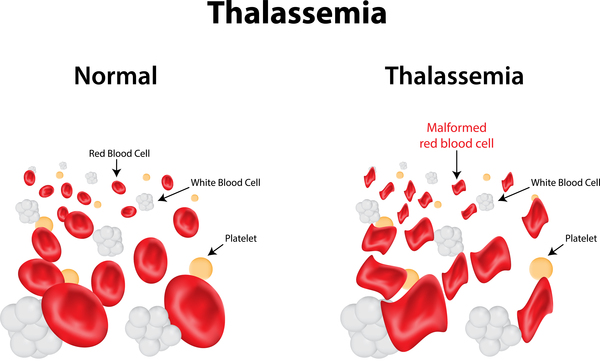 Tan máu bẩm sinh Thalassemia thể Alpha - Thiếu máu tán huyết 1