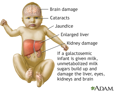 Rối loạn chuyển hóa đường galactose (Galactosemia) 3