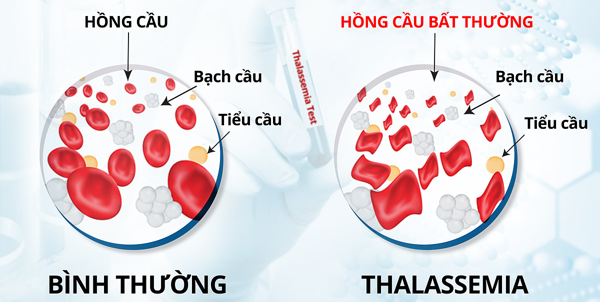 Thalassemia là gì