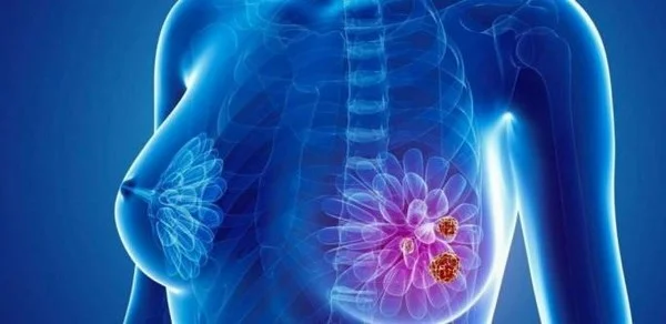 cách phát hiện ung thư vú sớm 1