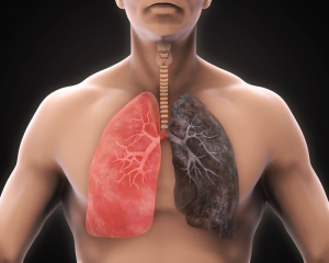 cách tầm soát ung thư phổi