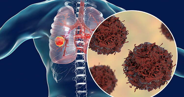Tầm soát ung thư phổi là gì