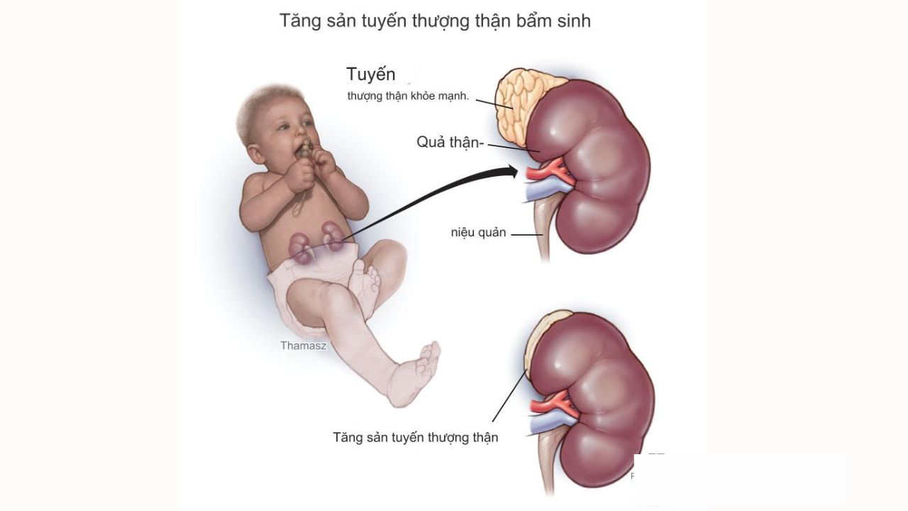 Gen lặn là gì? Một số bệnh di truyền gen lặn nguy hiểm 5