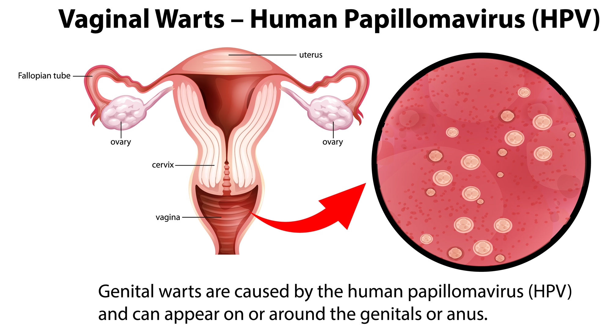 Tầm soát ung thư sớm có ý nghĩa gì? 2 Phát hiện sớm HPV có thể giúp ngừng sự phát triển của bệnh ngay từ khi còn ở giai đoạn sớm