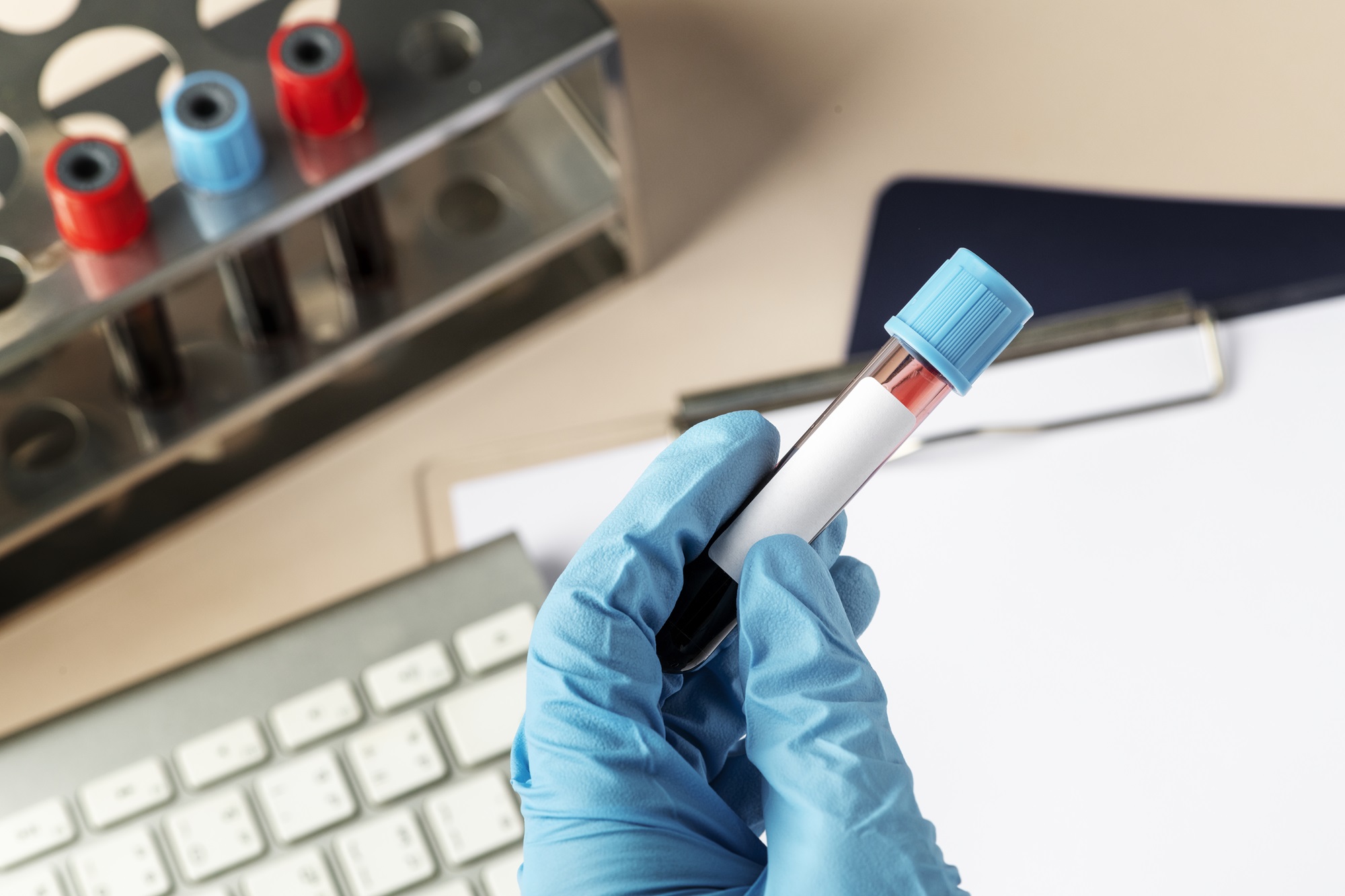 Nguyên nhân ung thư phổi & hướng dẫn tầm soát đúng cách 4 Xét nghiệm ctDNA là phương pháp phân tích DNA của tế bào ung thư thông qua mẫu máu