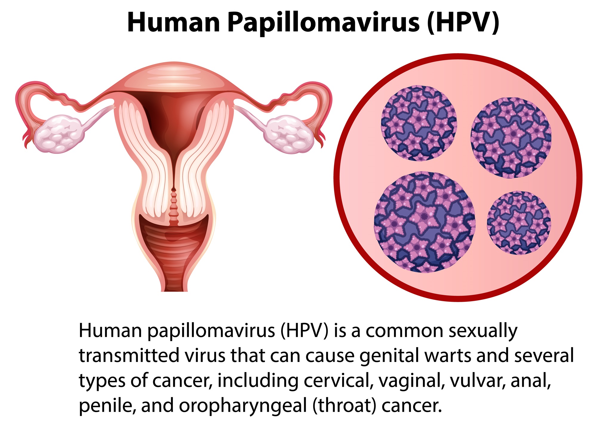Nguyên nhân ung thư cổ tử cung: Các yếu tố nguy cơ và phương pháp sàng lọc 2 HPV là nguyên nhân chính dẫn đến ung thư cổ tử cung