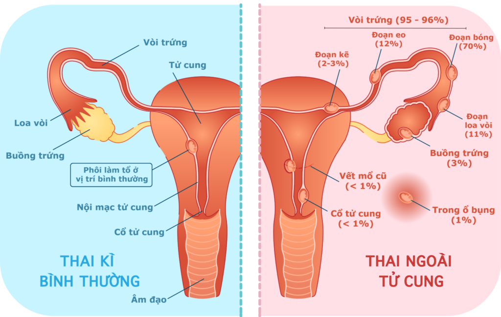 Dấu hiệu mang thai ngoài tử cung tháng đầu 1