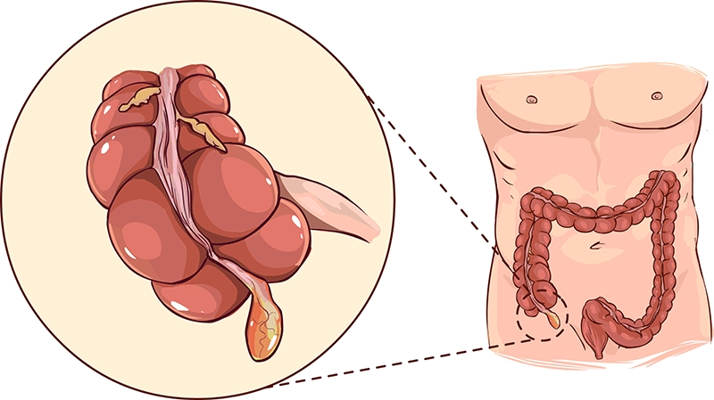 Ung thư ruột thừa là một dạng ung thư phát sinh từ các tế bào trong ruột thừa. Ảnh: drdannyshouhed.com 