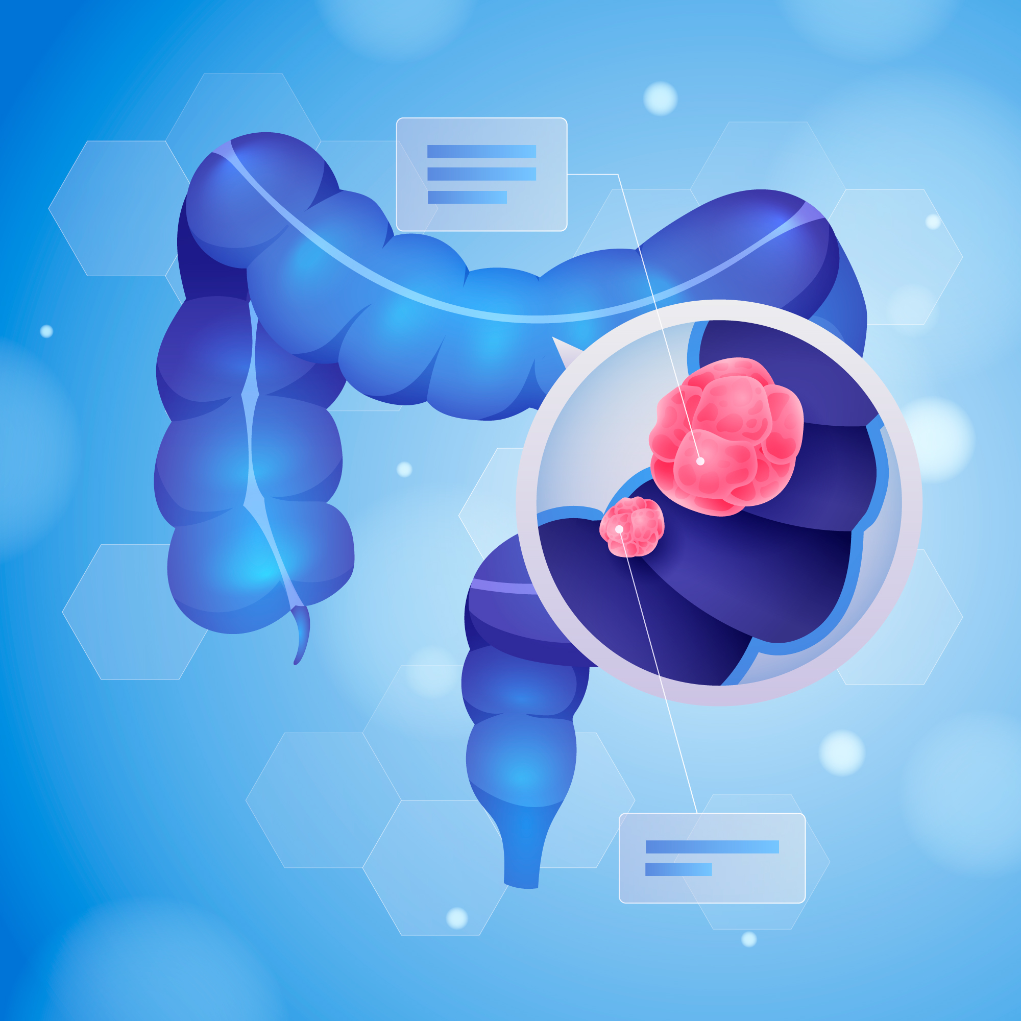 Ung thư đại tràng là bệnh ác tính bắt đầu từ lớp niêm mạc bên trong đại tràng