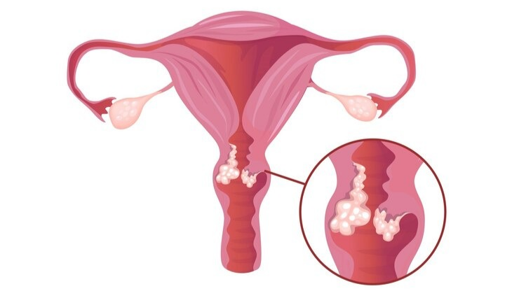Virus HPV là nguyên nhân chính gây ung thư cổ tử cung