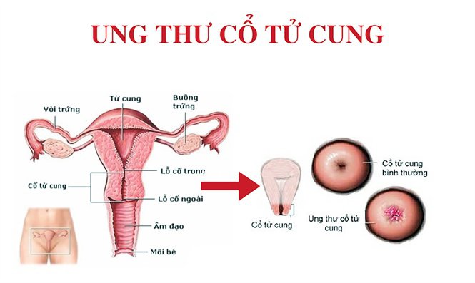 Tỉ lệ ung thư cổ tử cung tăng lên mỗi năm
