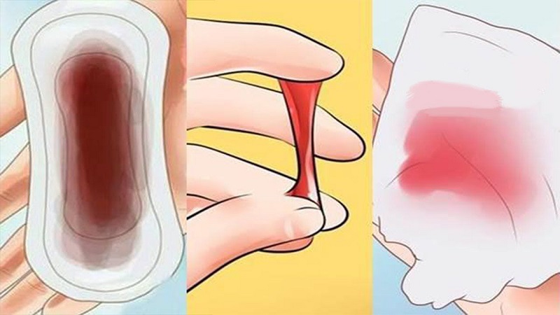 Ra máu âm đạo bất thường và kéo dài là một trong biểu hiện sớm của ung thư nội mạc tử cung