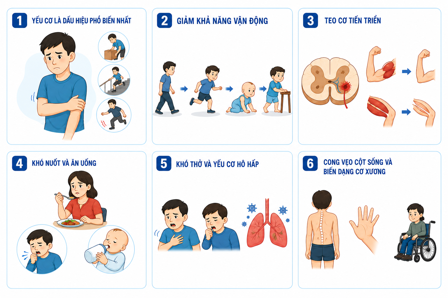 Dấu hiệu bệnh teo cơ tủy sống SMA