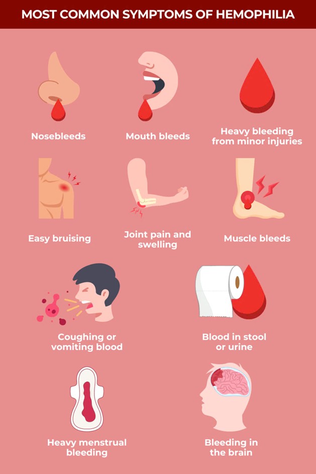 Các triệu chứng lâm sàng điển hình của bệnh máu khó đông Hemophilia A 