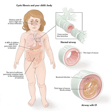Bệnh xơ nang (Cystic fibrosis) 1