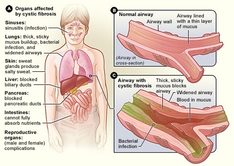 Bệnh xơ nang (Cystic fibrosis) 3