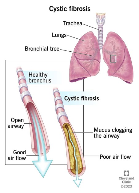 Bệnh xơ nang (Cystic fibrosis) 5