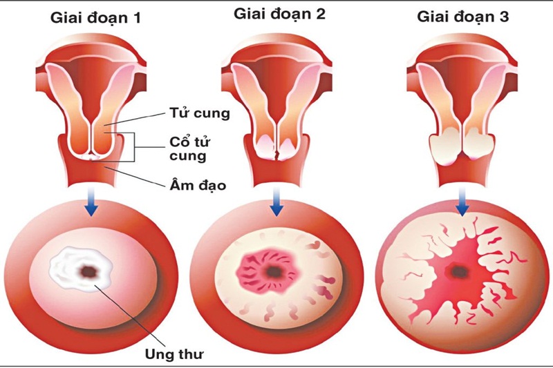 Giải mã ung thư cổ tử cung: Nguyên nhân, dấu hiệu và giải pháp tầm soát gen hiện đại  1
