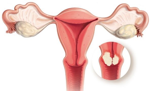 Giải mã ung thư cổ tử cung: Nguyên nhân, dấu hiệu và giải pháp tầm soát gen hiện đại
