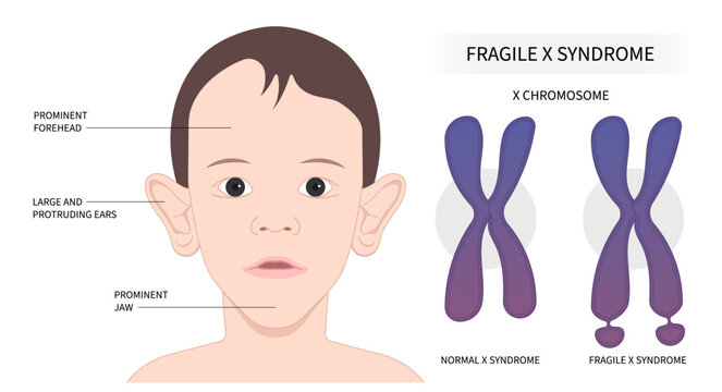 Hội chứng nhiễm sắc thể X dễ gãy (Fragile X)