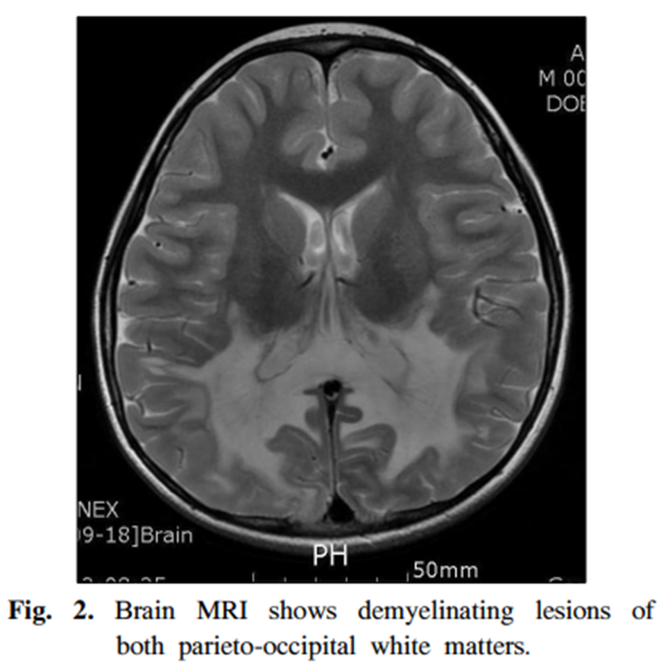 Loạn dưỡng chất trắng não - thượng thận (Adrenoleukodystrophy) 1