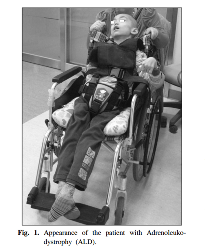 Loạn dưỡng chất trắng não - thượng thận (Adrenoleukodystrophy) 3