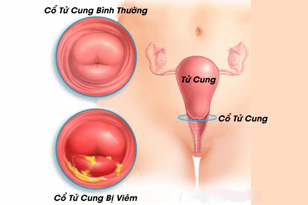 Những bệnh phụ khoa thường gặp: Nhận biết sớm để bảo vệ sức khỏe 3