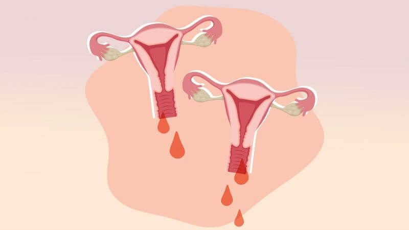 Chảy máu âm đạo bất thường có nguy hiểm không? Những dấu hiệu không nên chủ quan