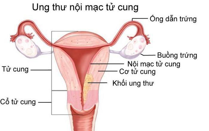 Chảy máu âm đạo bất thường có nguy hiểm không? Những dấu hiệu không nên chủ quan 5