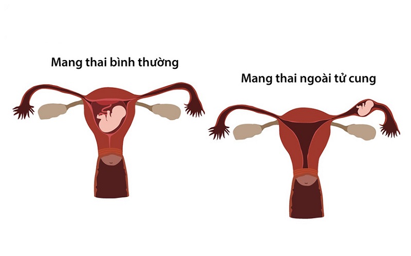 Chảy máu âm đạo bất thường: Nguyên nhân, triệu chứng và cách xử trí an toàn 3
