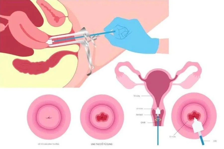 Hiểu rõ tình trạng ra máu ngoài kỳ kinh ở phụ nữ 6 Hiểu rõ tình trạng ra máu ngoài kỳ kinh ở phụ nữ 5