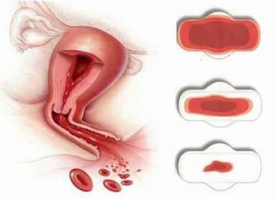 Kinh nguyệt kéo dài nguyên nhân do đâu? Cảnh báo những bệnh lý nào?