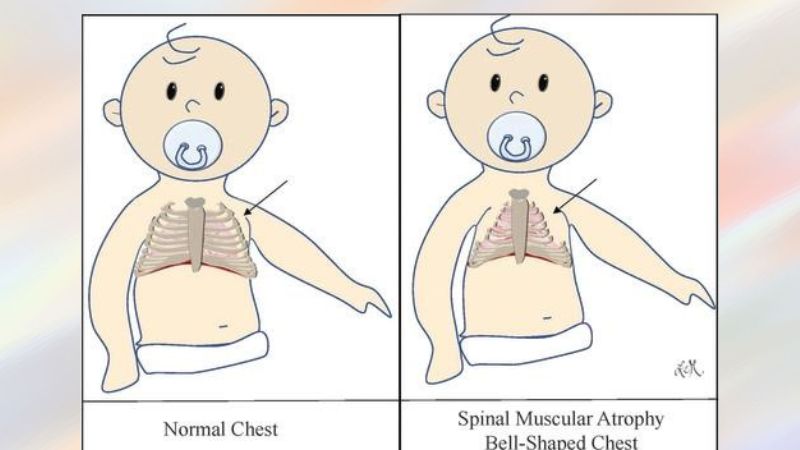 Đặc trưng của bệnh SMA là yếu và teo cơ tiến triển
