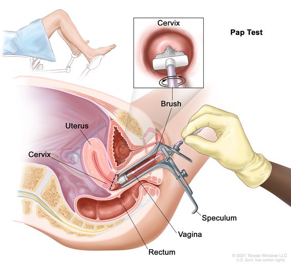 Hình ảnh minh họa của phương pháp Pap smear