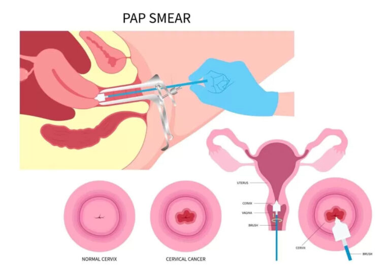 Kết quả HPV dương tính nhưng Pap bình thường có sao không?