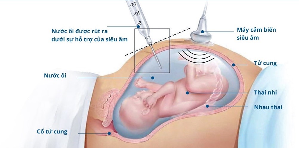 Chọc ối xét nghiệm dị tật thai nhi 