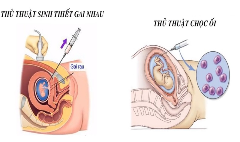 Hình ảnh minh họa cho thủ thuật sinh thiết gai nhau và thủ thuật chọc ối