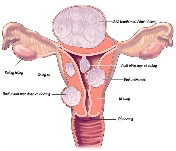 U xơ tử cung là khối u lành tính phát triển từ lớp cơ tử cung
