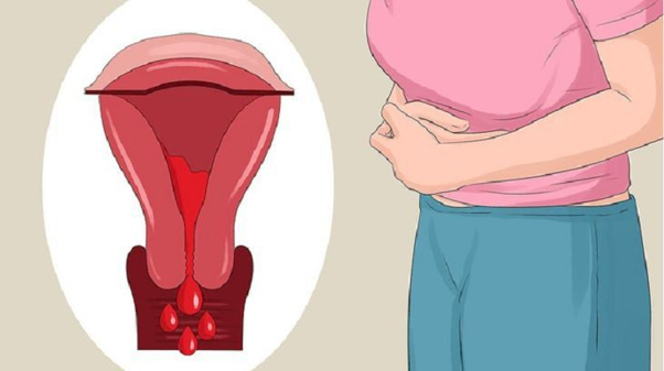 Ra máu âm đạo bất thường