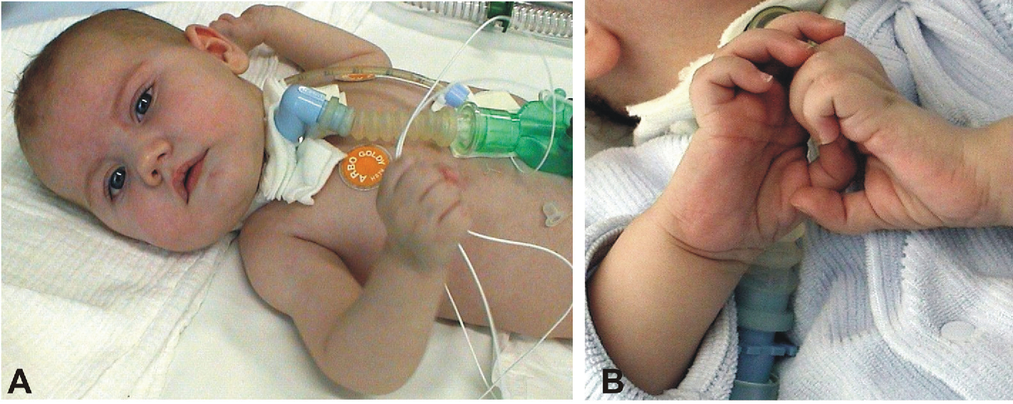 Suy hô hấp sớm ở trẻ sơ sinh có thể là dấu hiệu bệnh Teo cơ tủy sống SMA