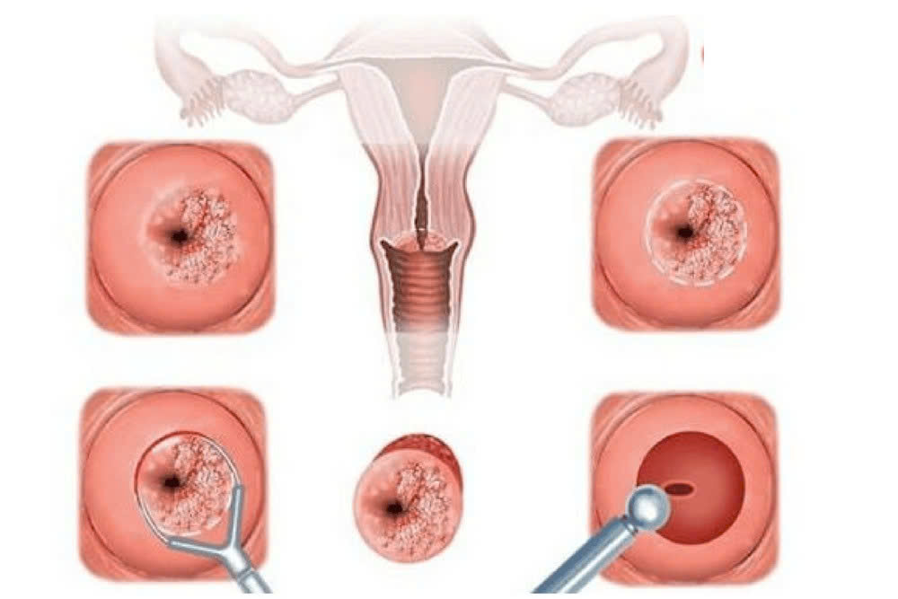 Viêm cổ tử cung có gây ung thư không? Những điều phụ nữ cần biết để bảo vệ sức khỏe 2 Viêm cổ tử cung có gây ung thư không? Những điều phụ nữ cần biết để bảo vệ sức khỏe 1