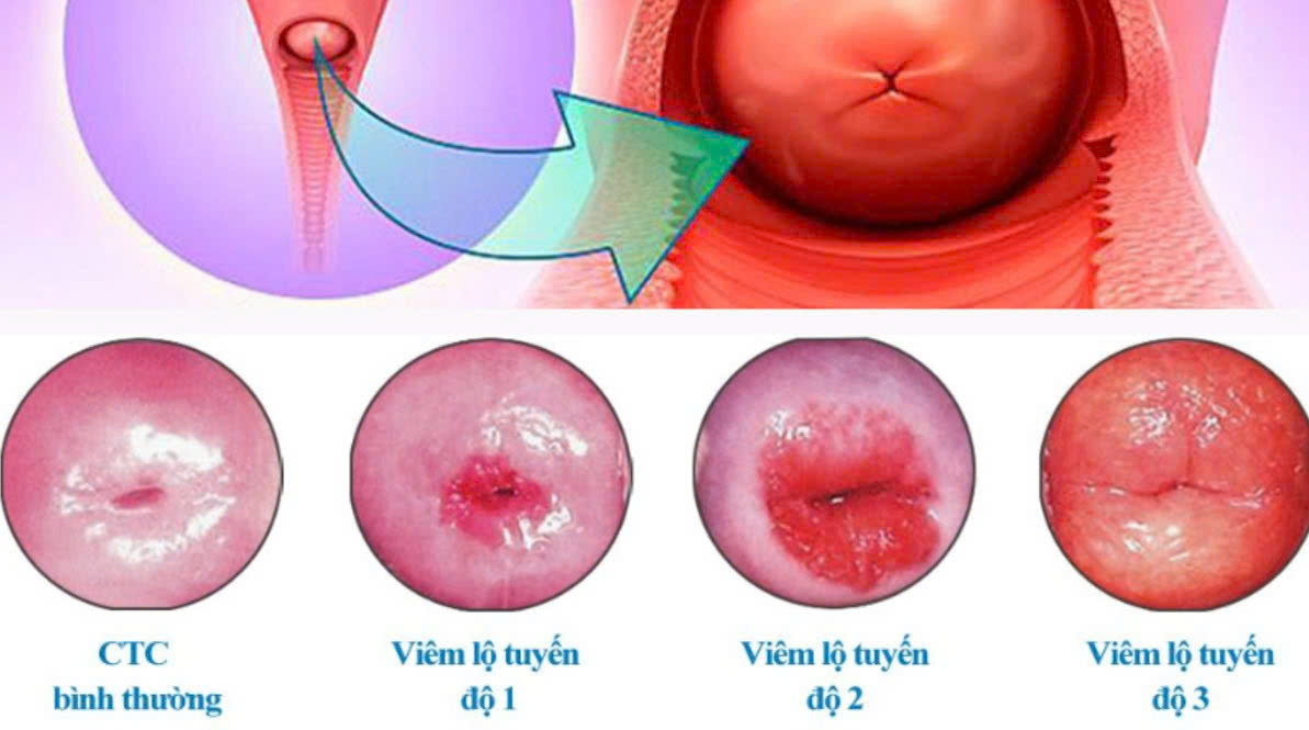 Viêm lộ tuyến có thành ung thư cổ tử cung không? 4 Viêm lộ tuyến có thành ung thư cổ tử cung không? 3