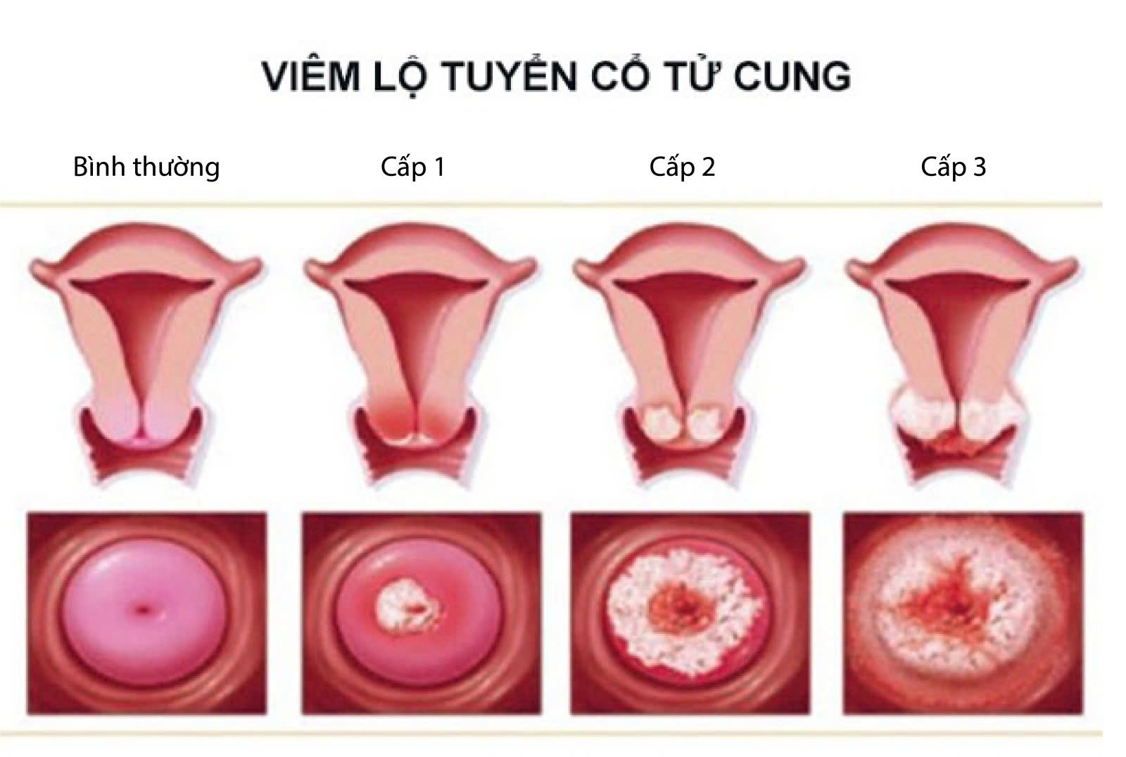 Viêm lộ tuyến và tổn thương tiền ung thư có liên quan với nhau không? 1